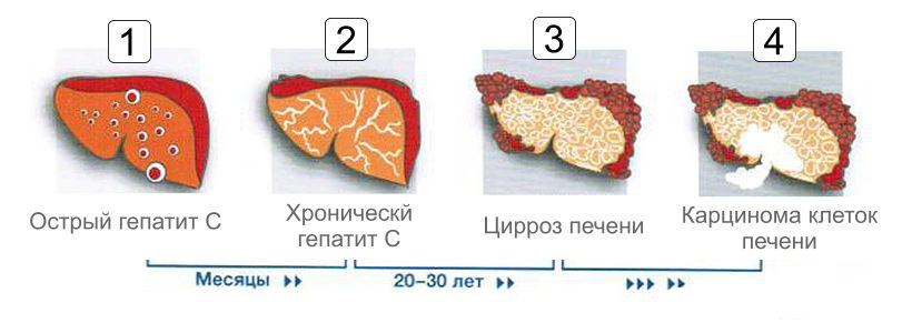 Гепатит С в хронической умеренной степени активности. Лечение. Прогнозы