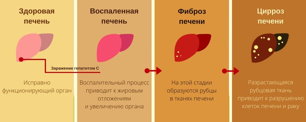 Лечится ли вирусный гепатит С полностью у взрослых и детей