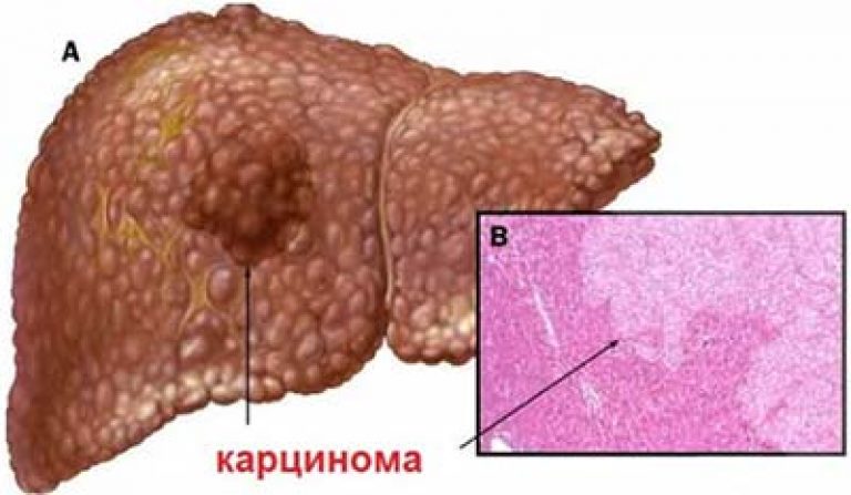 Стадии хронического гепатита С